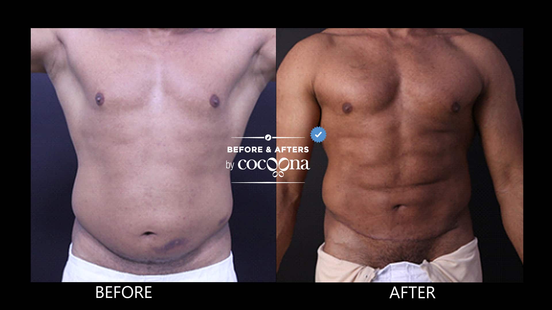 High definition body sculpting - Where art meets surgical science - Cocoona  Blog