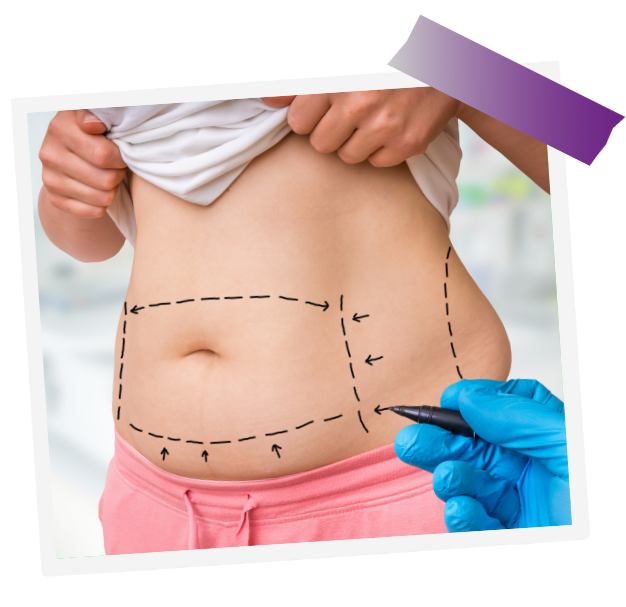 Waist Liposuction In Dubai