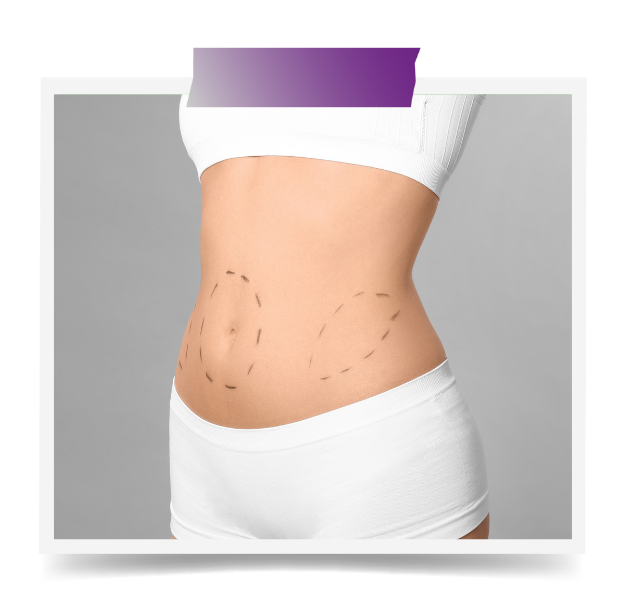 Waist Liposuction In Dubai