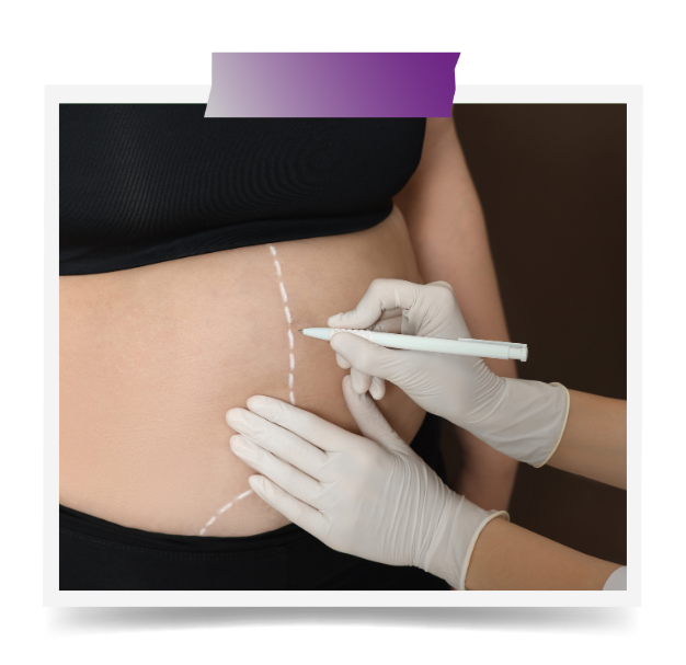 Full Body Liposuction In Dubai