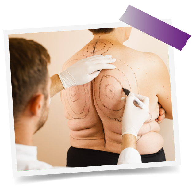 Back Liposuction In Dubai