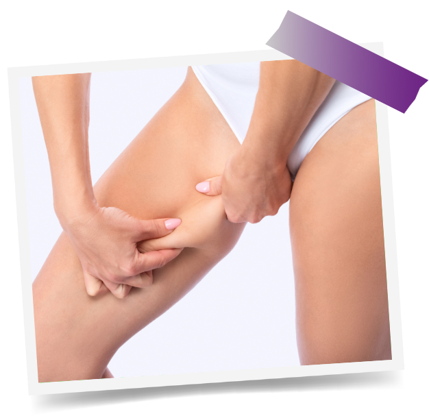 Thigh Liposuction In Dubai